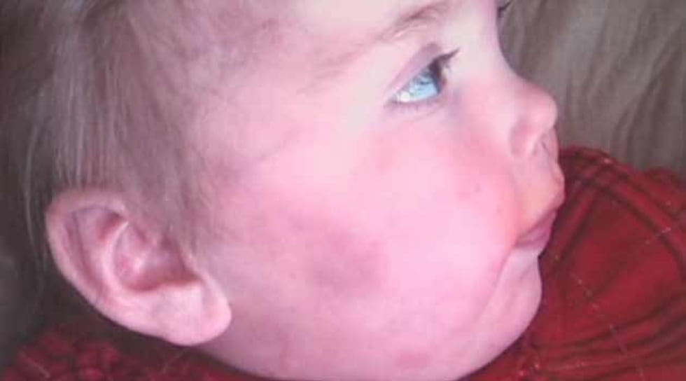 A photo of bruising the child suffered.