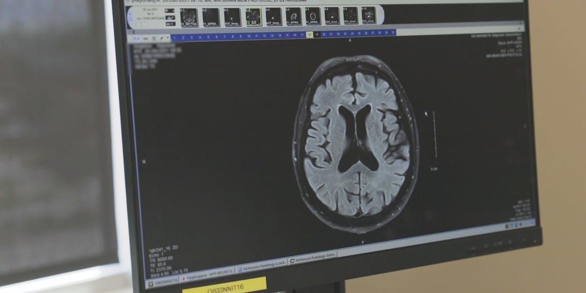 New research may predict when Alzheimer’s symptoms begin