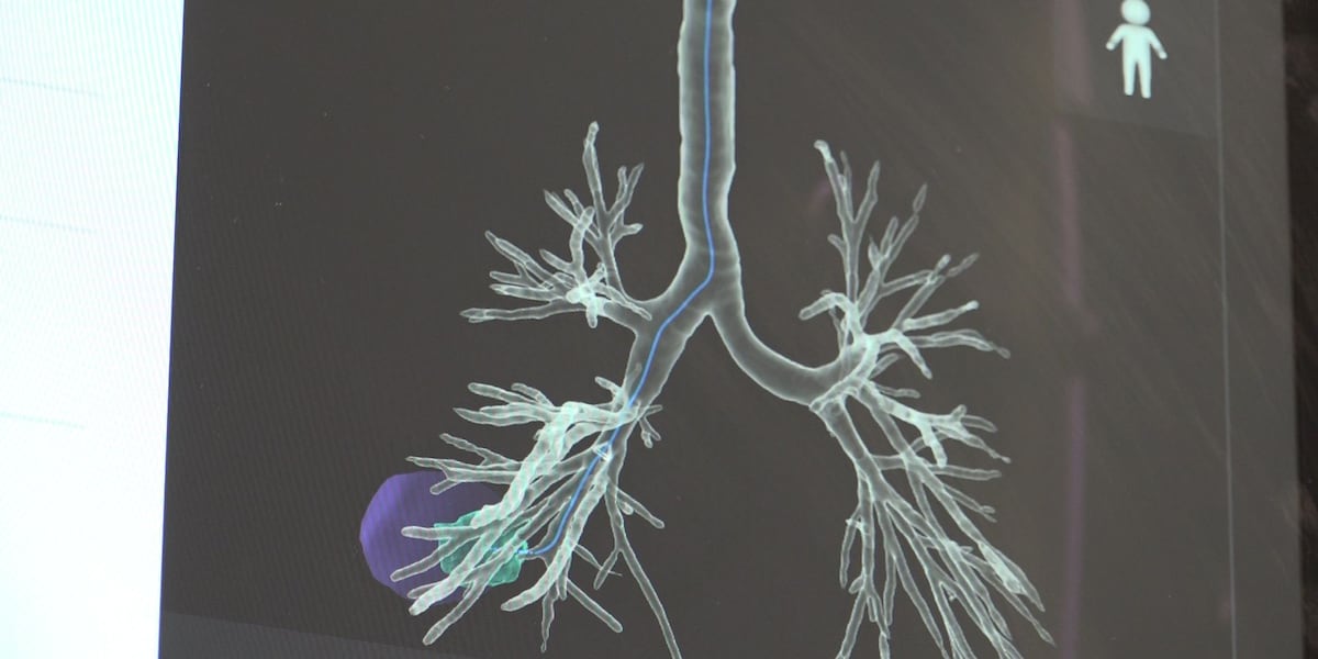 Breakthrough Technology Enables Early Lung Cancer Detection